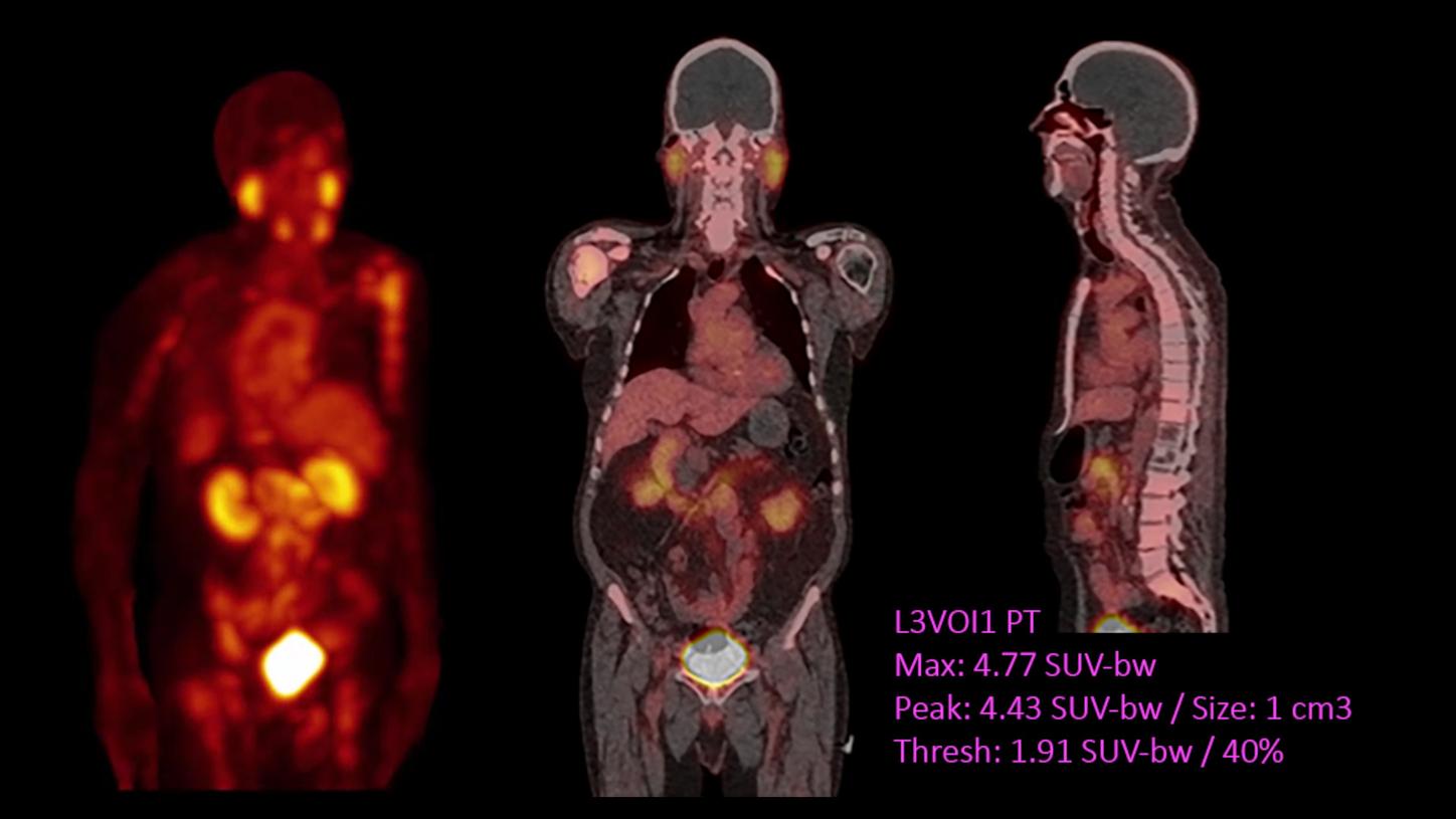 Fast dual-peak Broad Quantification - PSMA-avid tumors