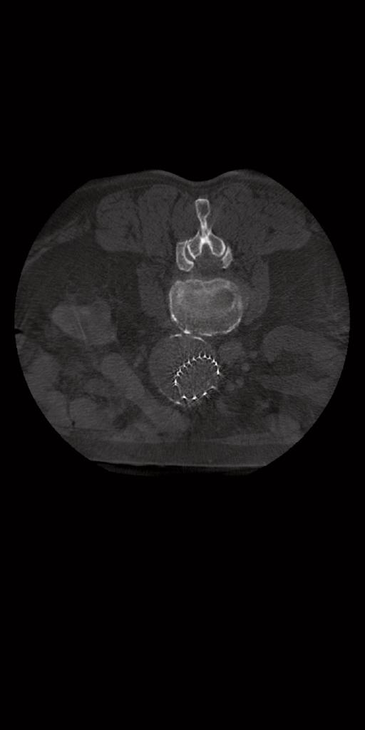Clinical image showing a deployed stent graft deployment generated using syngo DynaCT