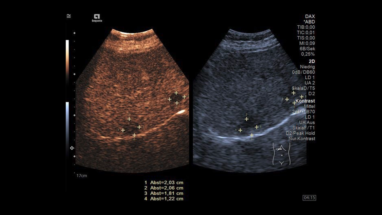 CEUS Liver