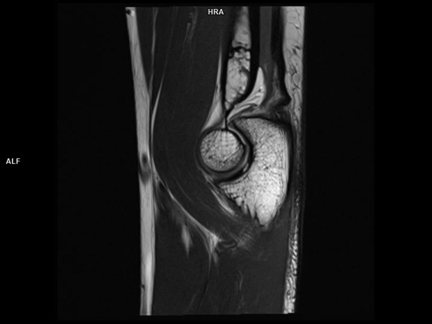 Sagittal T2 TSE-MAGNETOM Lumina