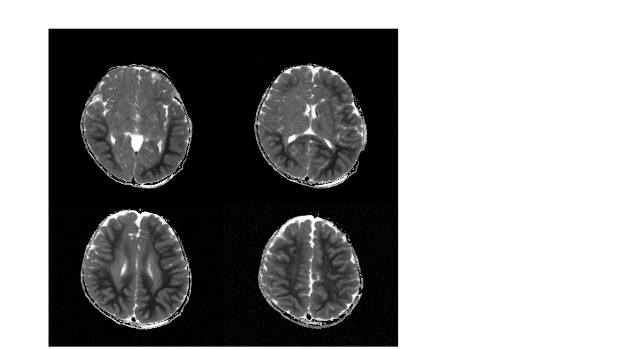 resolve diffusion MRI