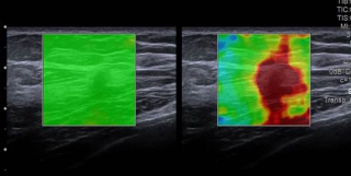 Image B The elastography image demonstrates homogeneous red elasticity, indicating higher velocities within the mass compared to the surrounding breast tissue, suggestive of marked stiffness.