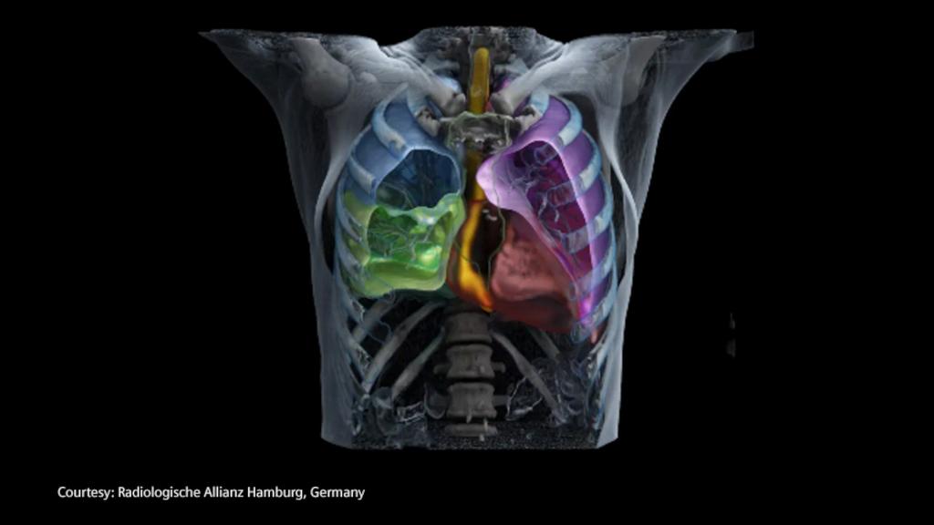 Diagnosis And Treatment Of Lung Cancer - Siemens Healthineers