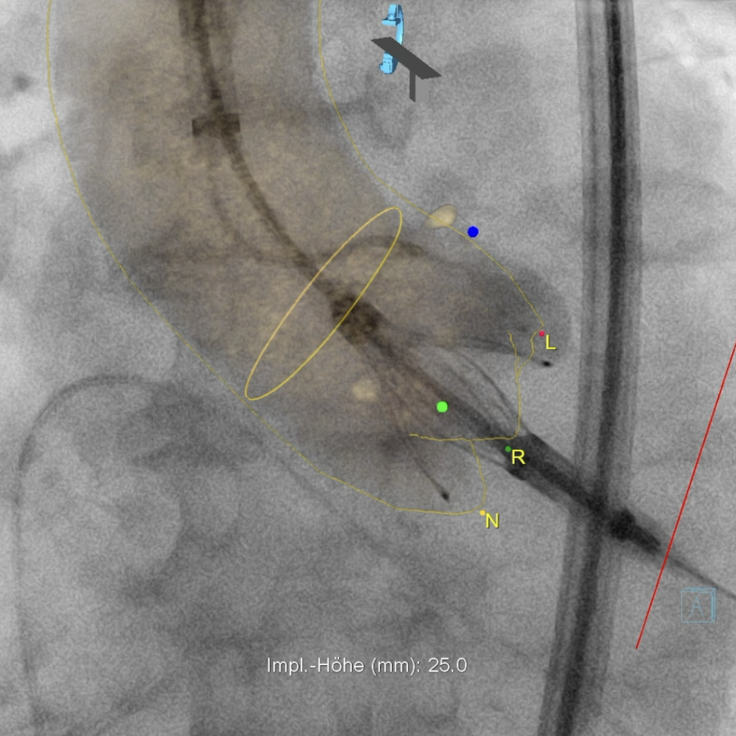 Beispiel einer CT-Angiofusion