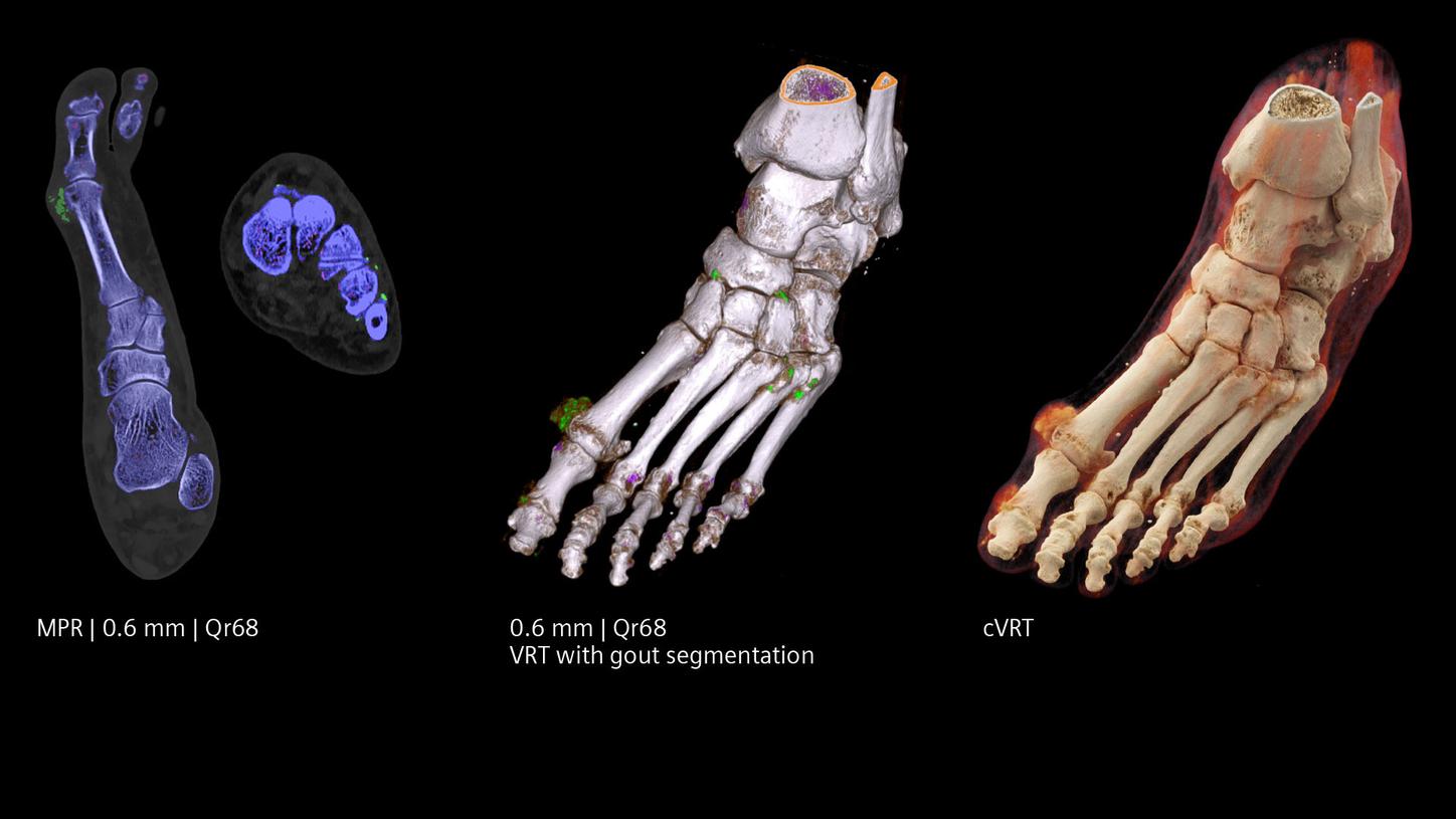 Clinical images of a gout spectral analysis