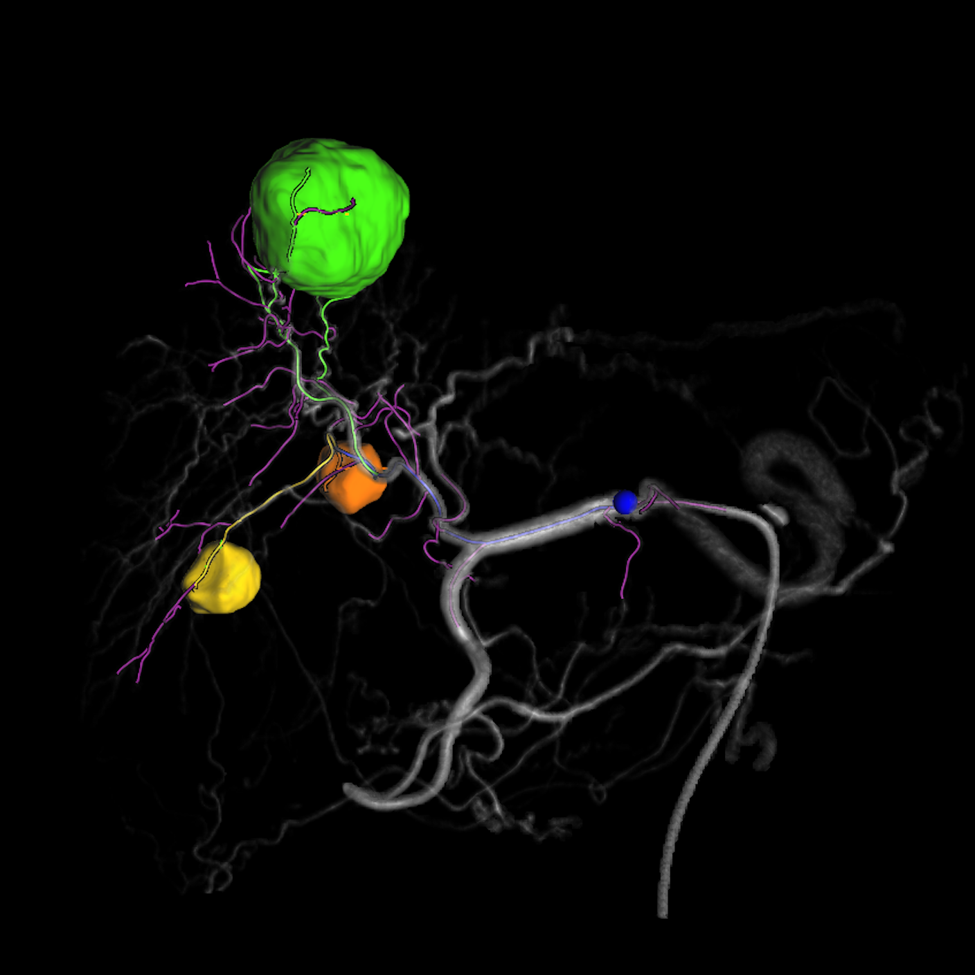embolization planning