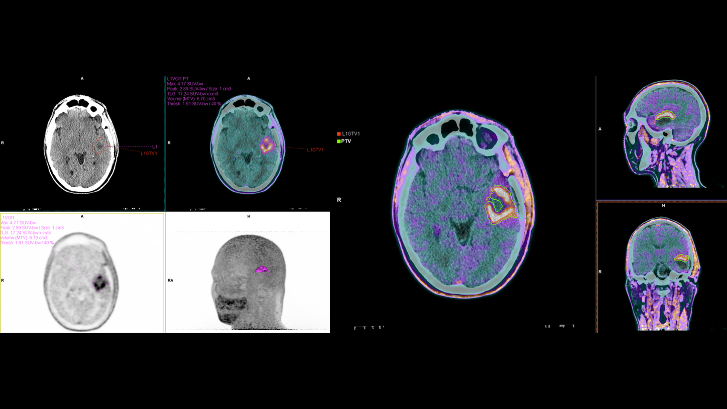 Brain cancer