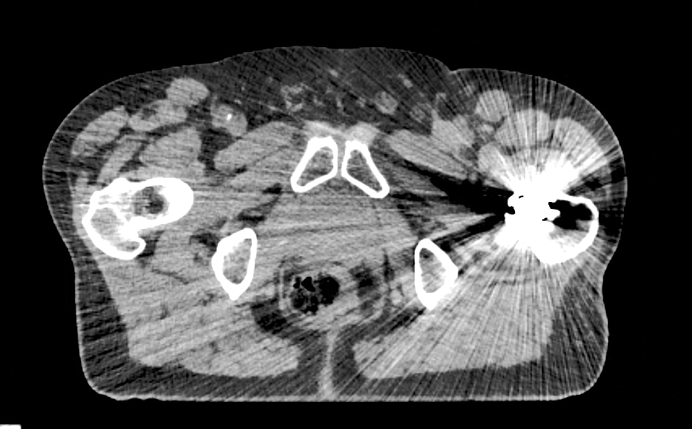 artificial intelligence in radiation oncology