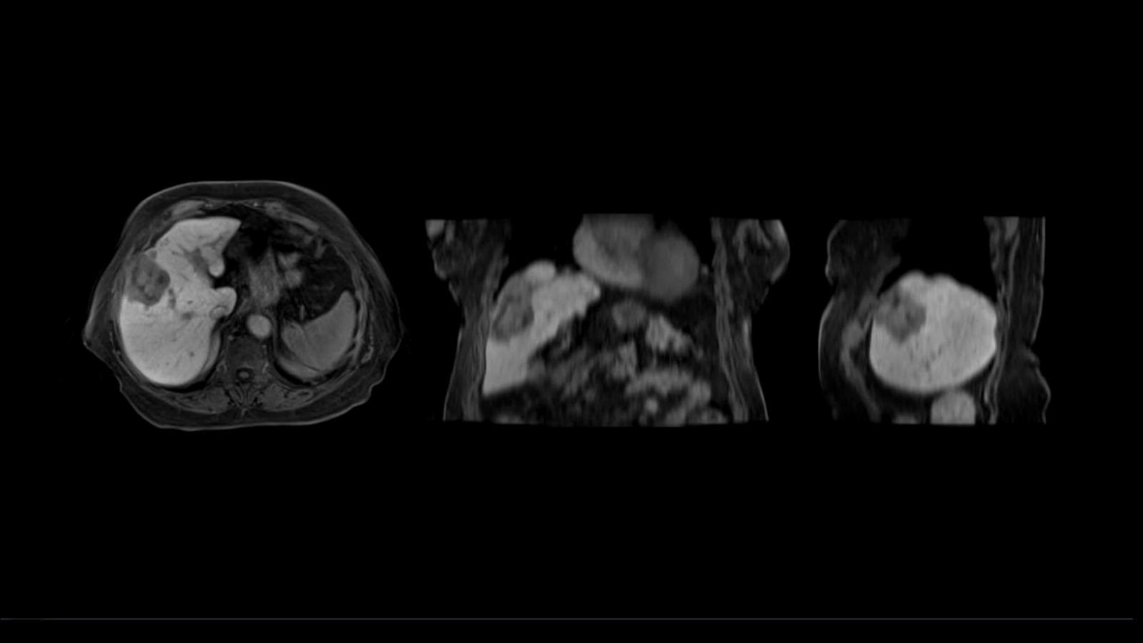 4D MRI – RT Respiratory Self-Gating - Siemens Healthineers Türkiye