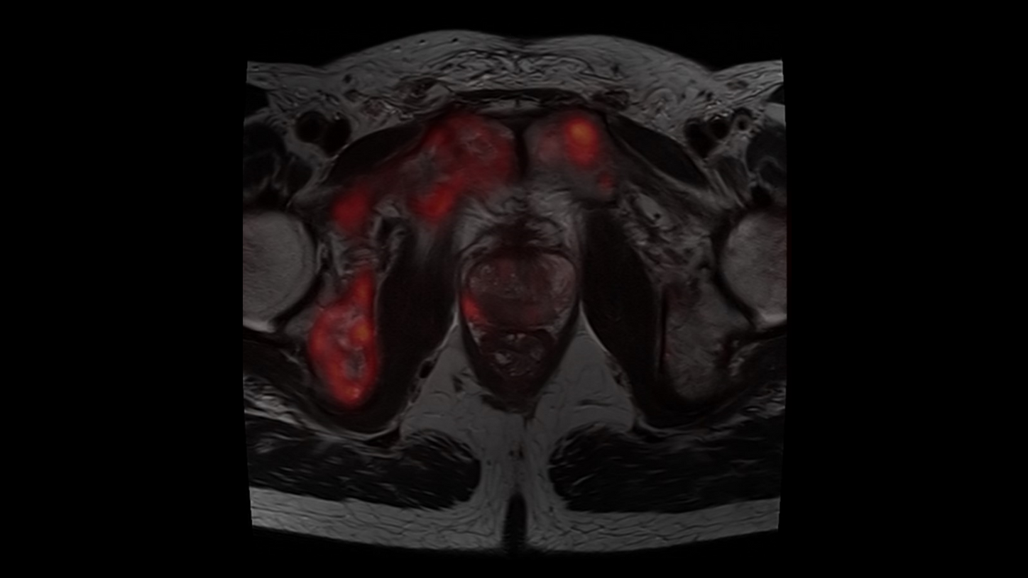siemens-healthineers_DI-MR_BIOGRAPH-One_prostate_cancer