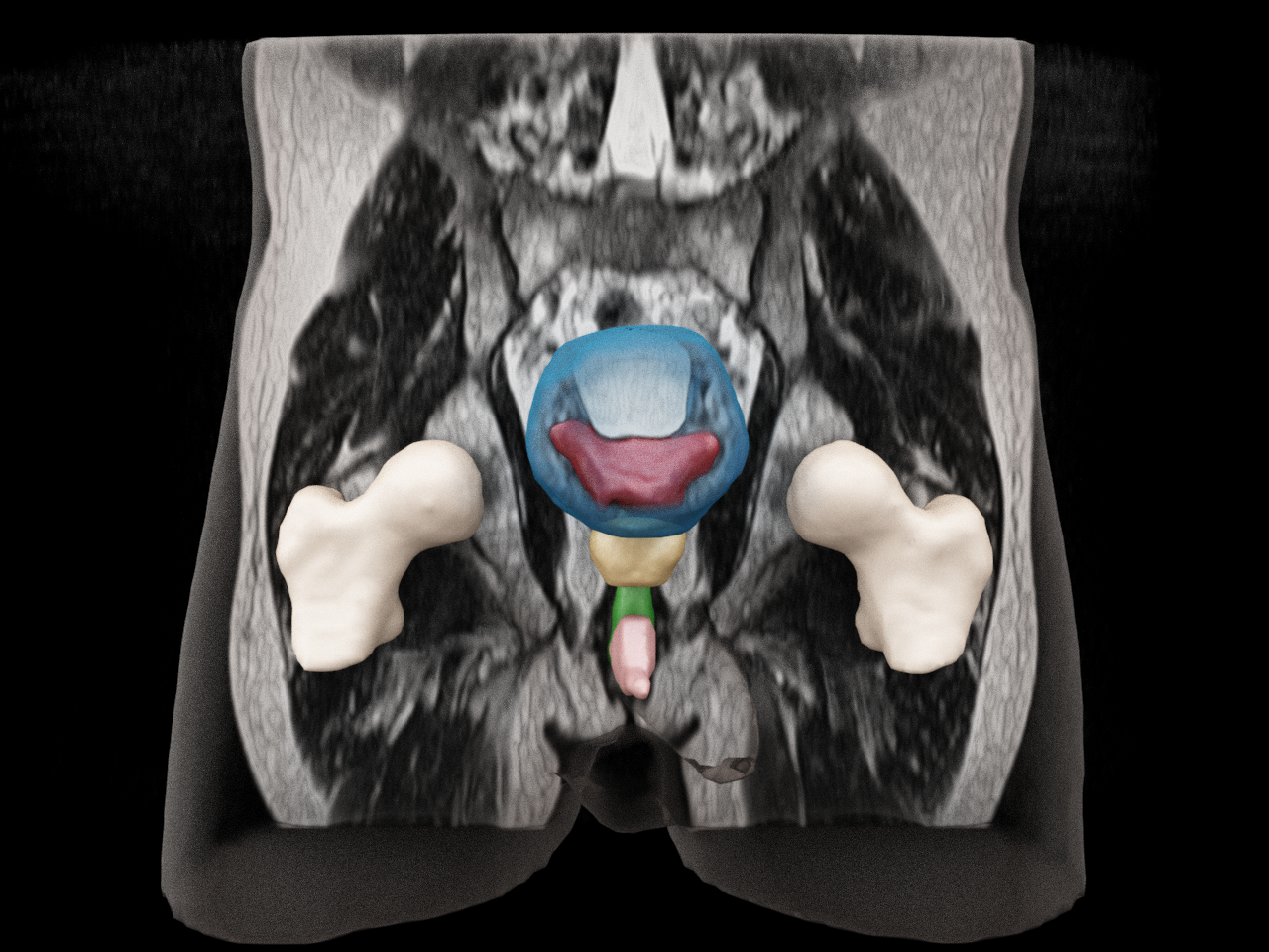 syngo.via RT Image Suite supports brain and pelvis OAR contouring and brain metastases contouring for MR data