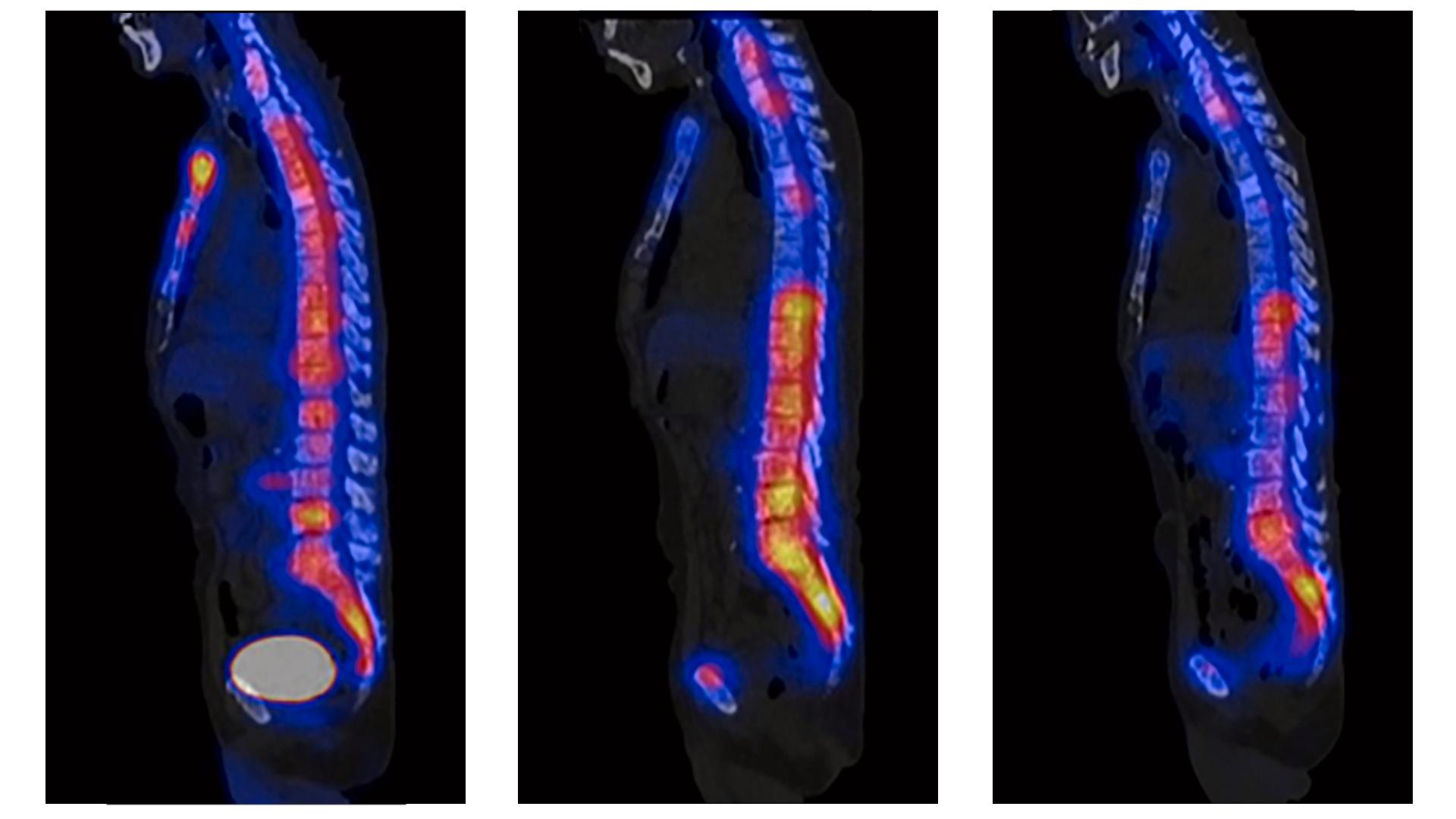 A physician’s experience: Theranostics offers personalized care for ...