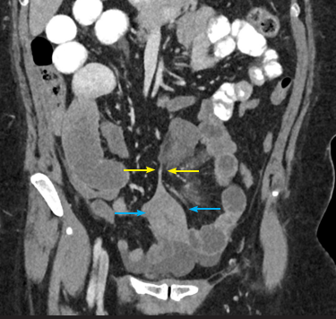 Coronal CT scan (oral and IV contrast) showed a fibrotic band (yellow arrow) extending from the fundus of uterus (blue arrow) upward to the site of transitional zone.