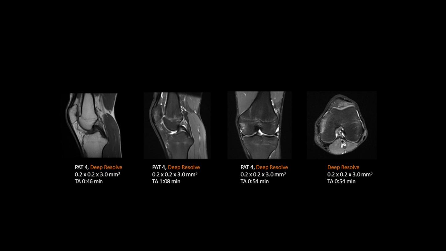 A complete knee in under 4 mins with Deep Resolve and MAGNETOM Aera