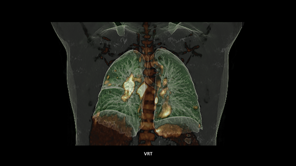 Biograph Vision clinical case