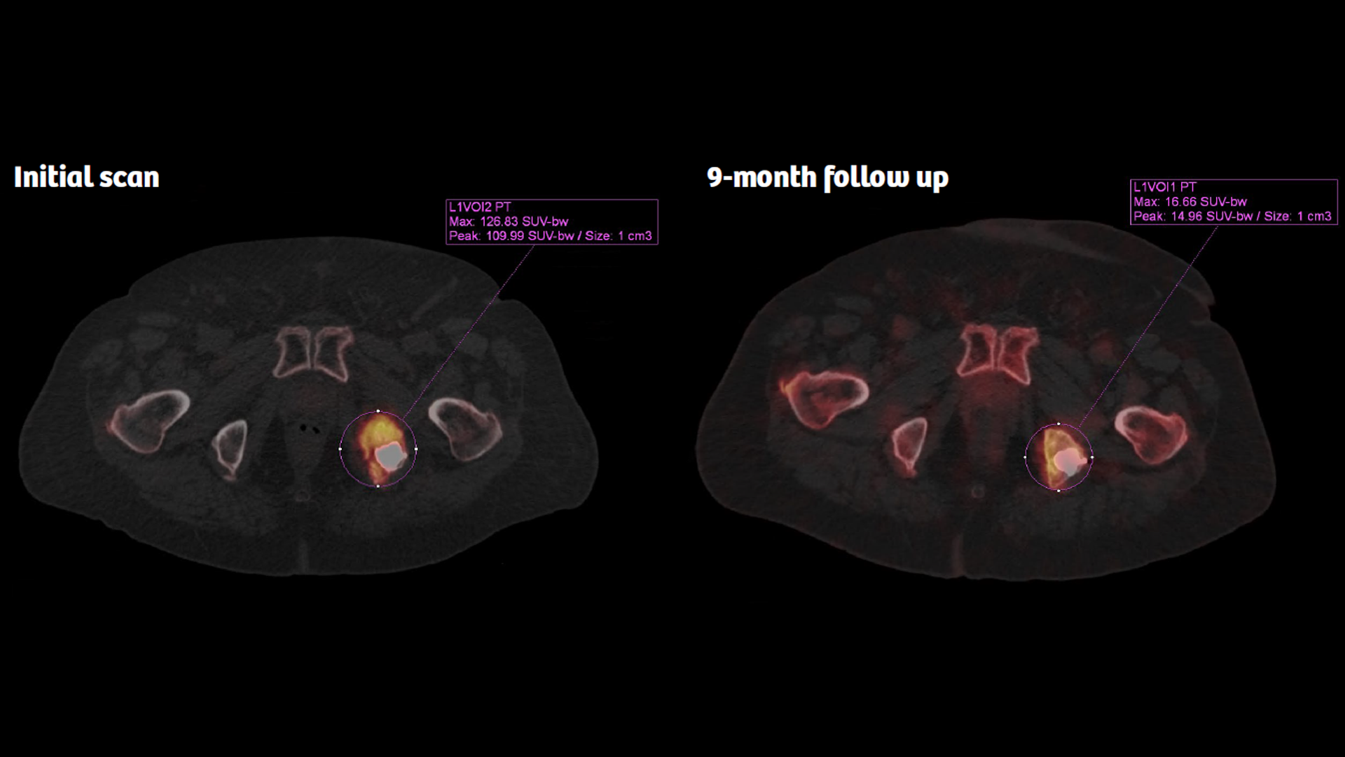 Evaluating SPECT/CT Quantification in Clinical Practice - Siemens