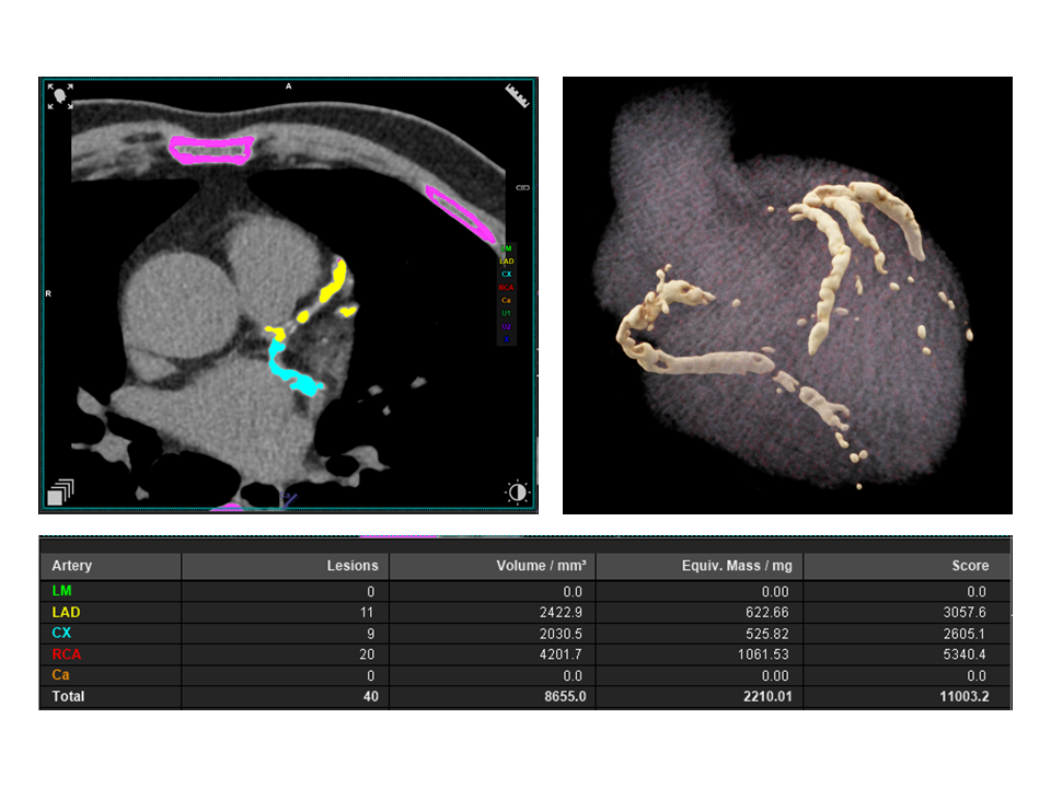 Quantitative summary of calcium scoring with a cumulative Agaston score of 11,000, reflects a high burden of calcification
