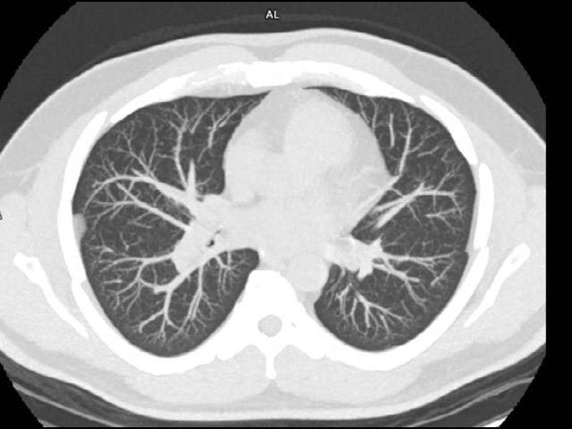Tin Filter Low Dose Lung Screening