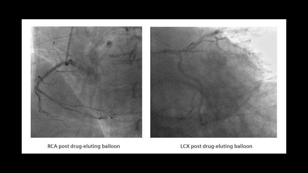 PET/CT delineation of multivessel coronary artery disease and post ...