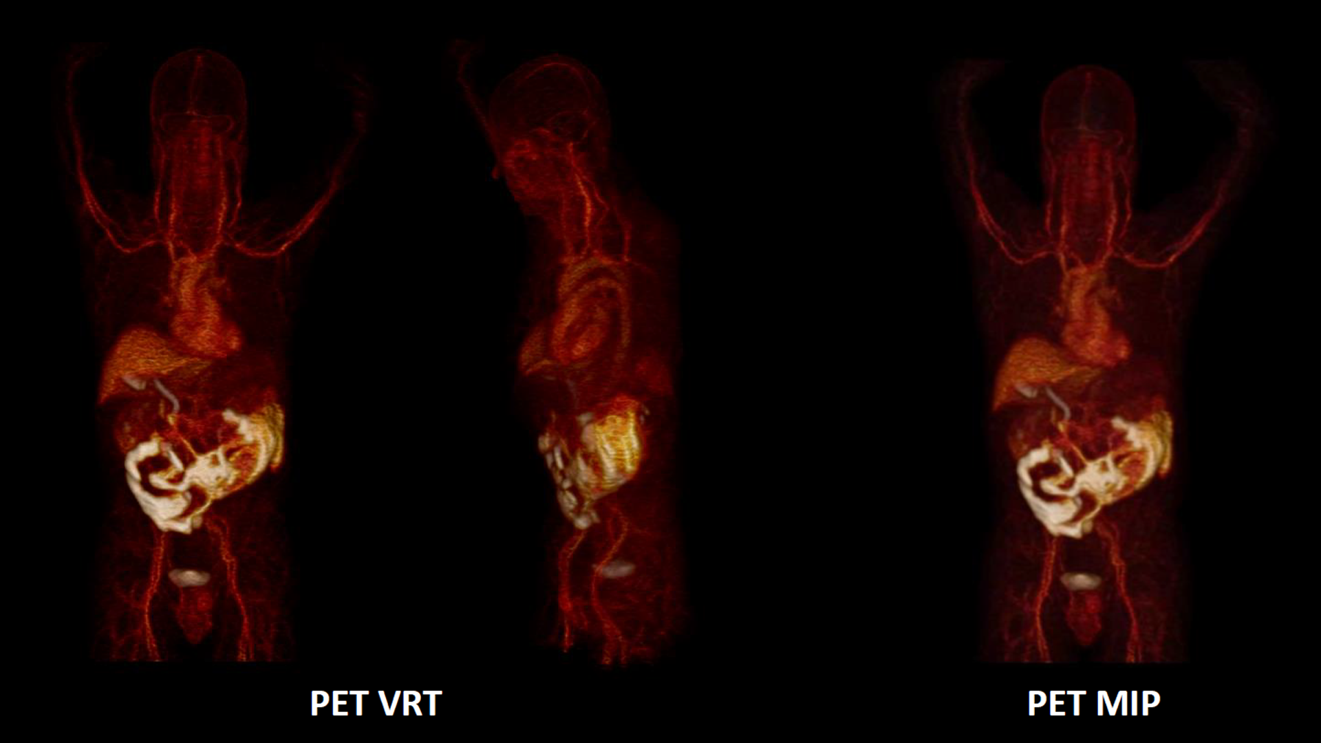 Biograph Vision PET/CT Scanner - Siemens Healthineers