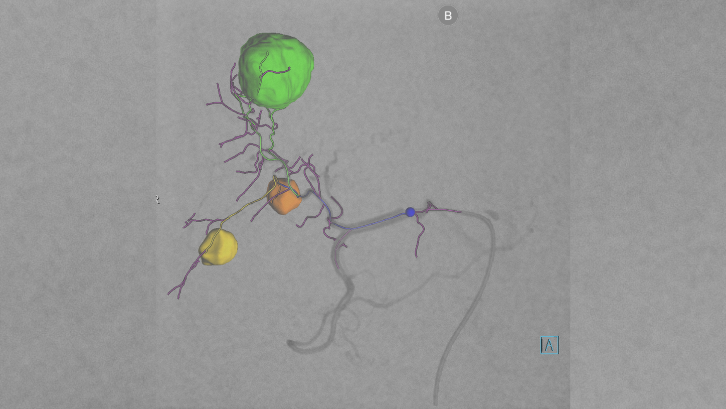 Overlay of planning results on live fluoroscopy images for real-time guidance.
