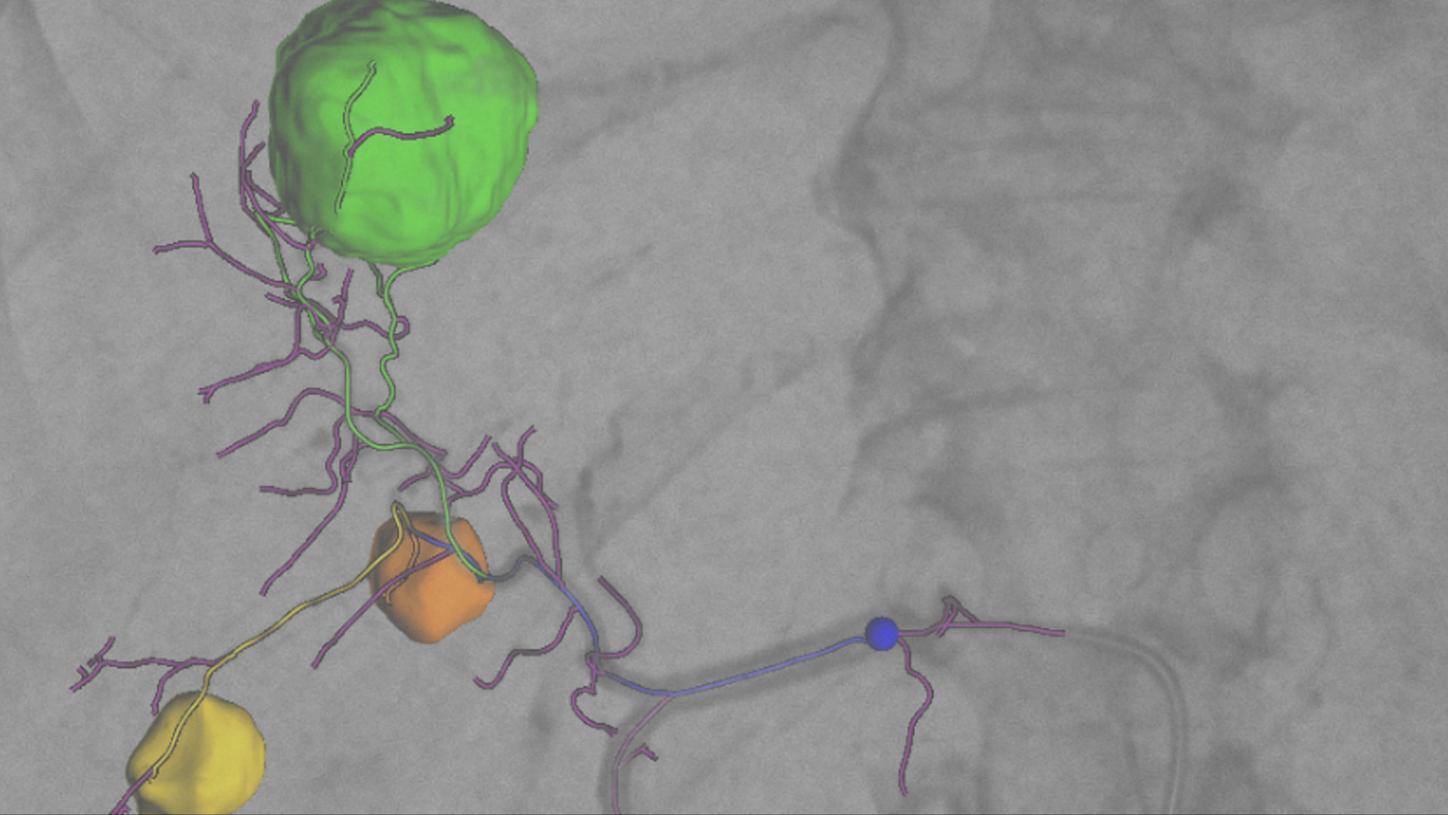 Overlay of planning results on live fluoroscopy images for  real-time guidance.