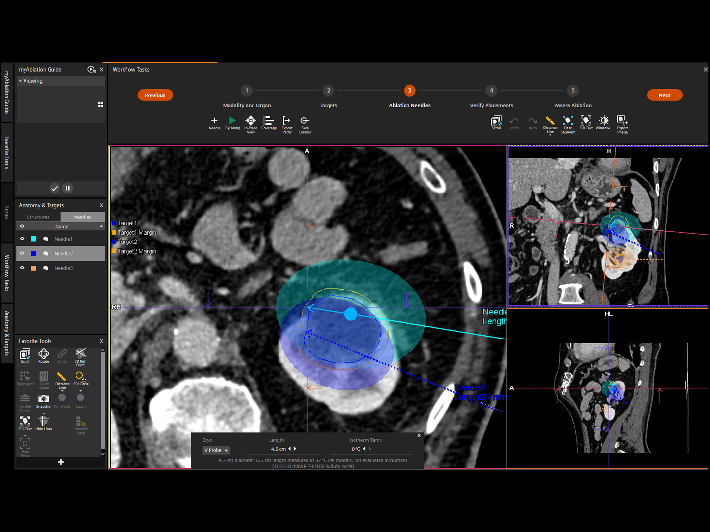 Advanced Multi-Probe Planning for confident Cryo and Microwave Ablation