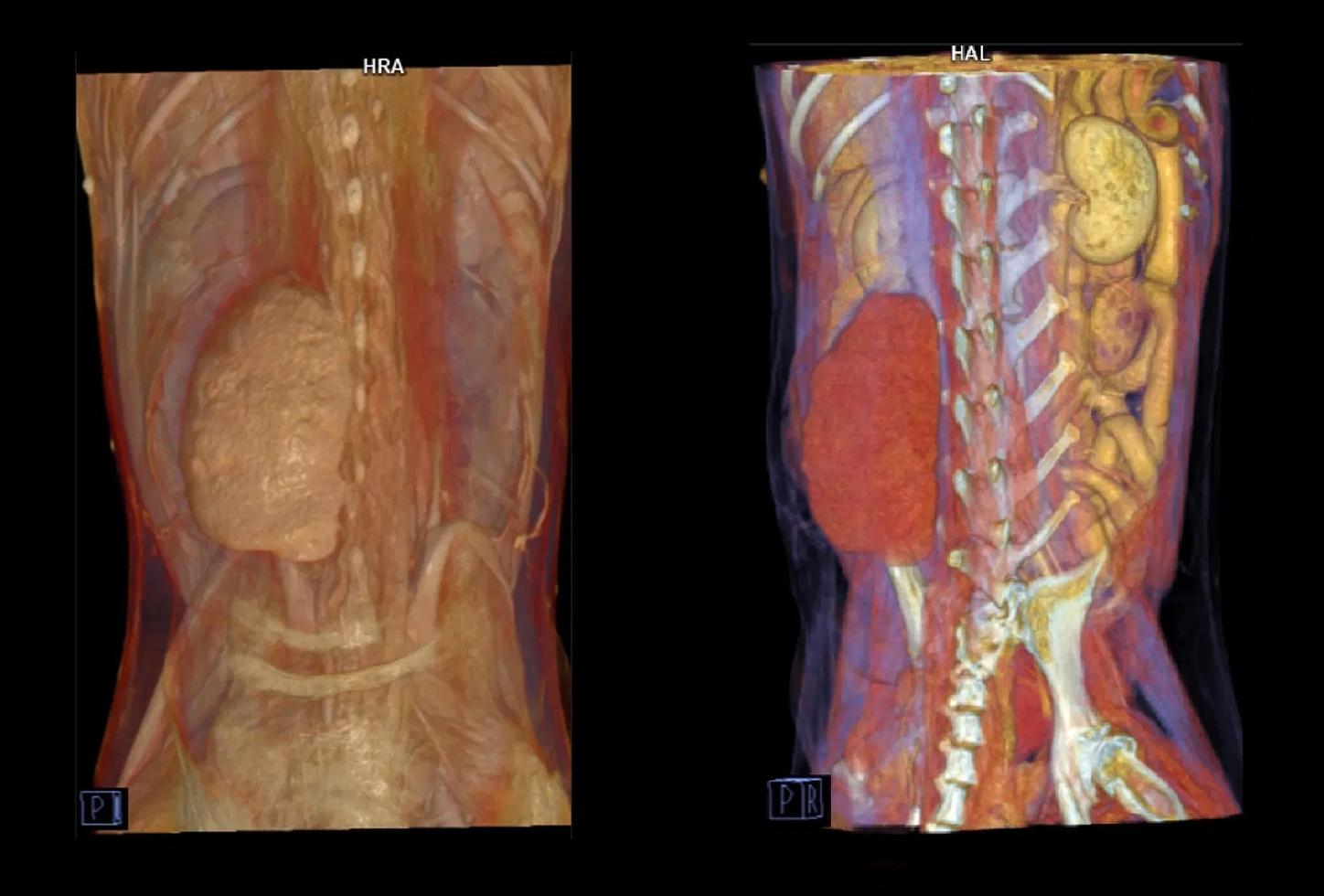 hemanglosarcoma tac vet
