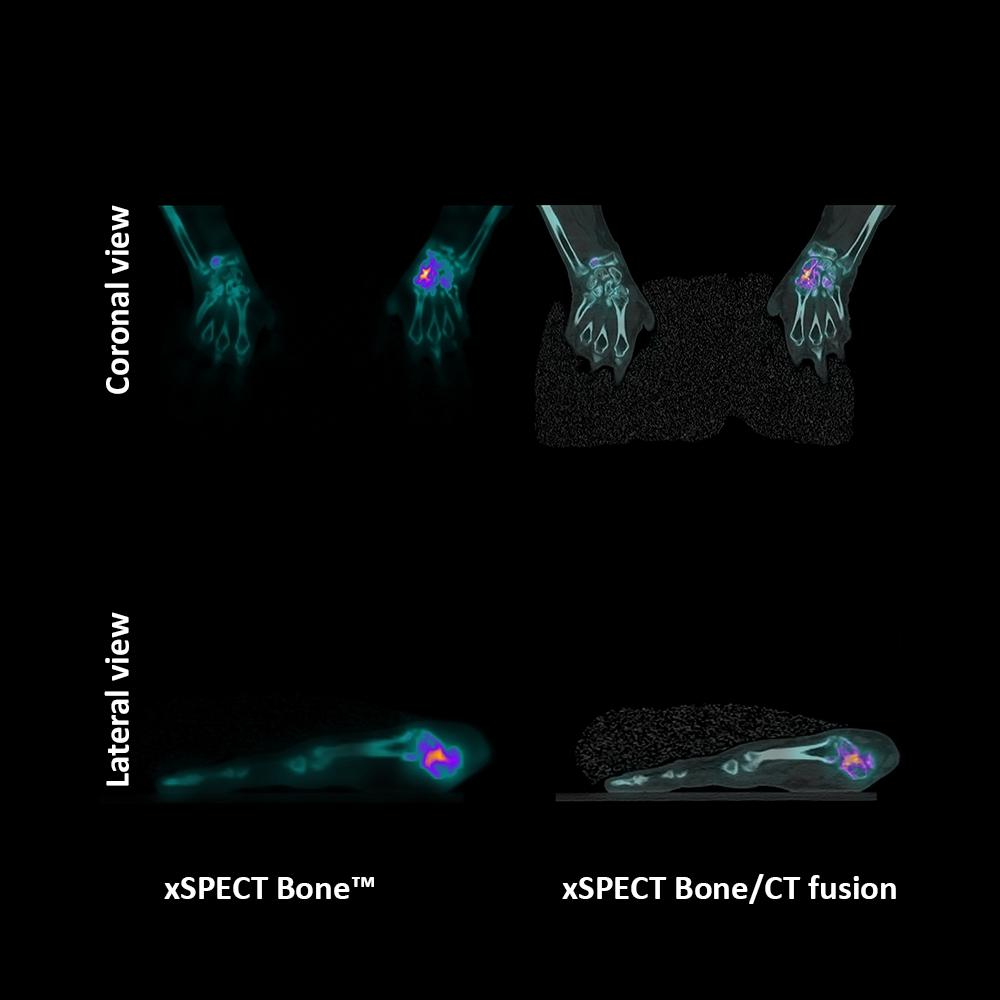 xSPECT Bone shows excellent anatomical detail of the carpal bones in a patient with scaphoid fracture