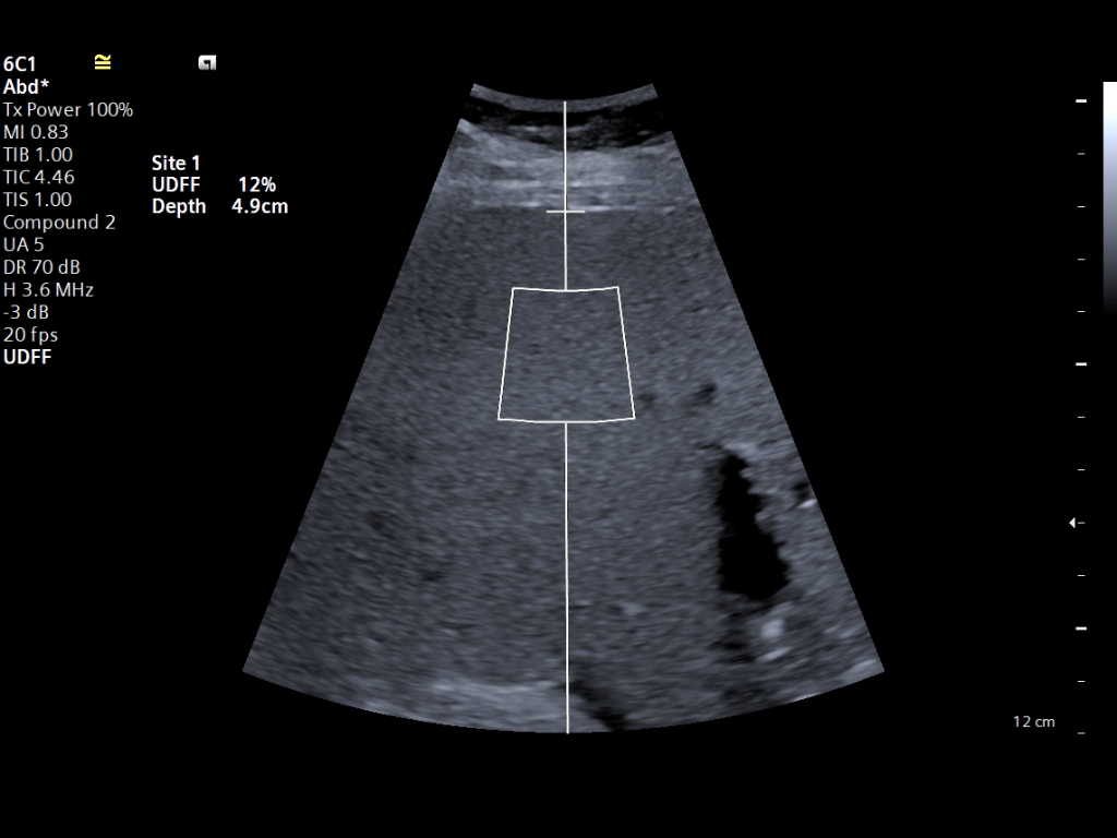 Ultrasound-derived fat fraction