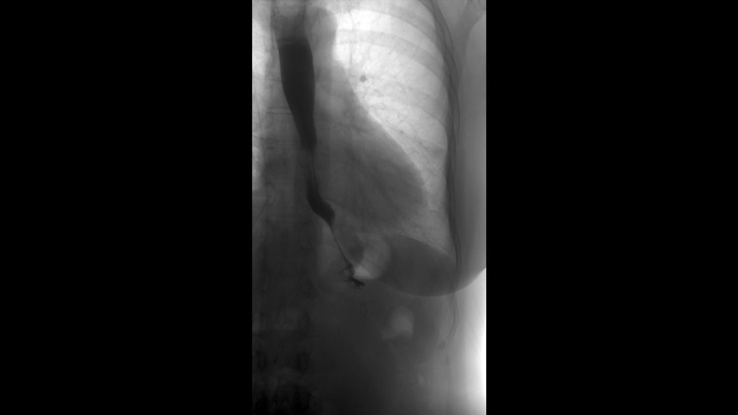 DI XP Luminos Qnamix Esophagus Stomach