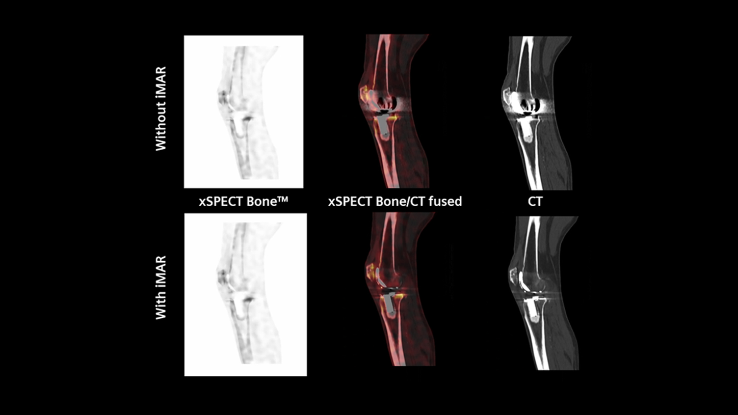 Siemens Healthineers nuclear medicine knee scan using iMAR.