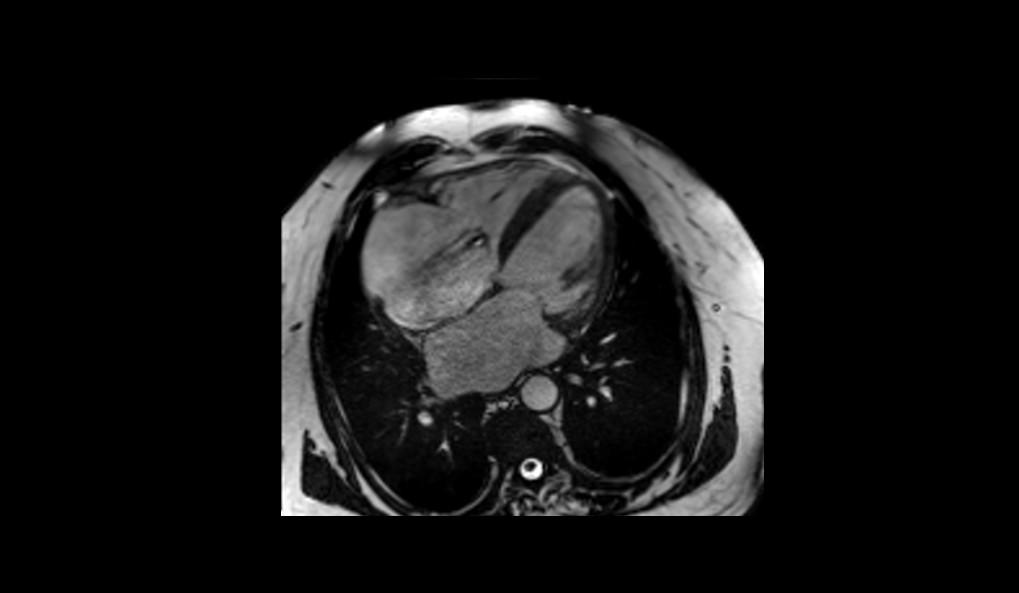 Cardiomiopatía dilatada