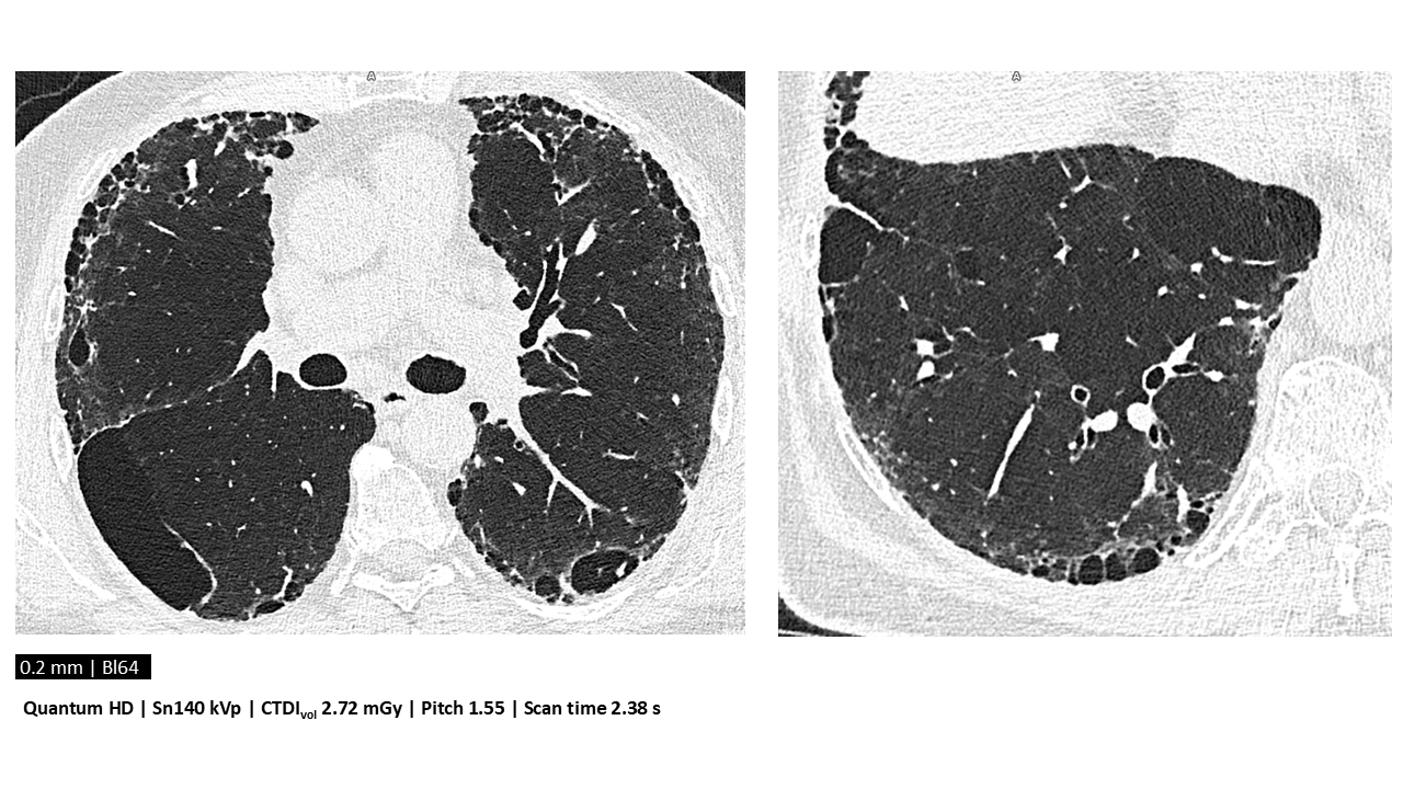 Lung assessment combining Quantum HD images with low radiation dose