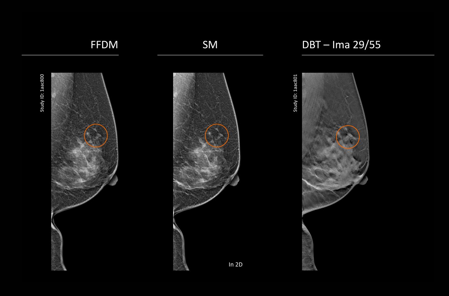 CT image of retro-ocular masses causing exophthalmos along with bilateral perinephric, pericardial, and pelvic exudates