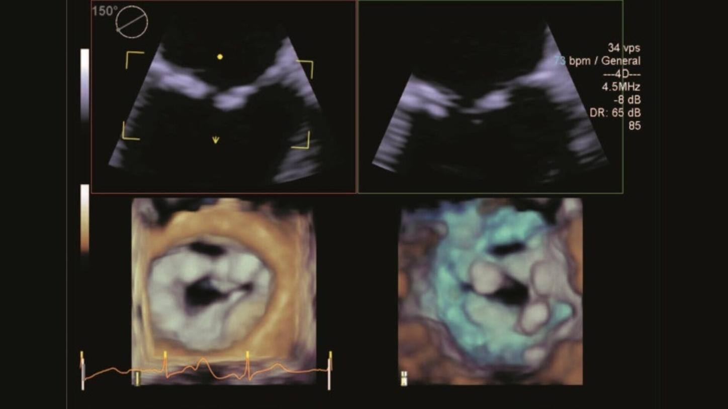 Implanting a Lotus valve in a severely stenotic mitral valve 