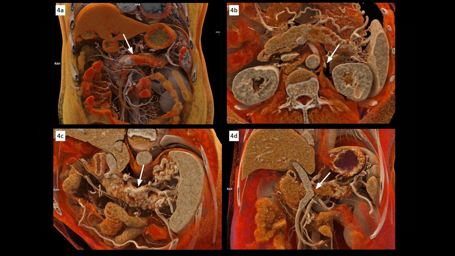 cVRT images show a distinctly delineated tumor in the pancreatic body, causing notably encasement of the splenic artery, and occlusion of the splenic vein. The left celiac ganglion, thickened and enhanced, is confirmed as a metastasis by pathological analysis after surgery. Images reconstructed at 0.2 mm with a sharp kernel of Bv48 are used to create these cVRT images.