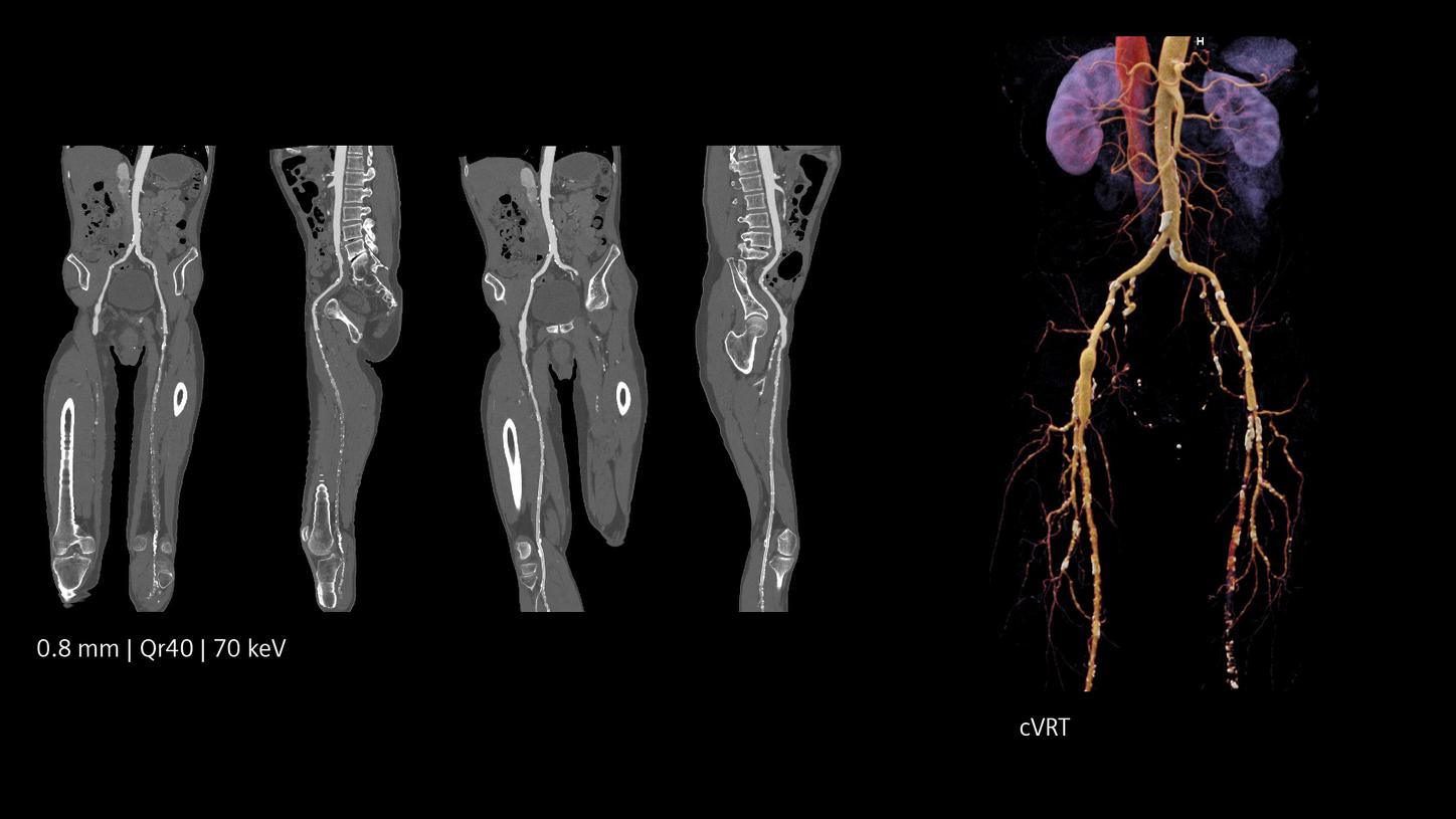 Highly detailed clinical cardiovascular images, acquired at low radiation dose with CTA runoff.