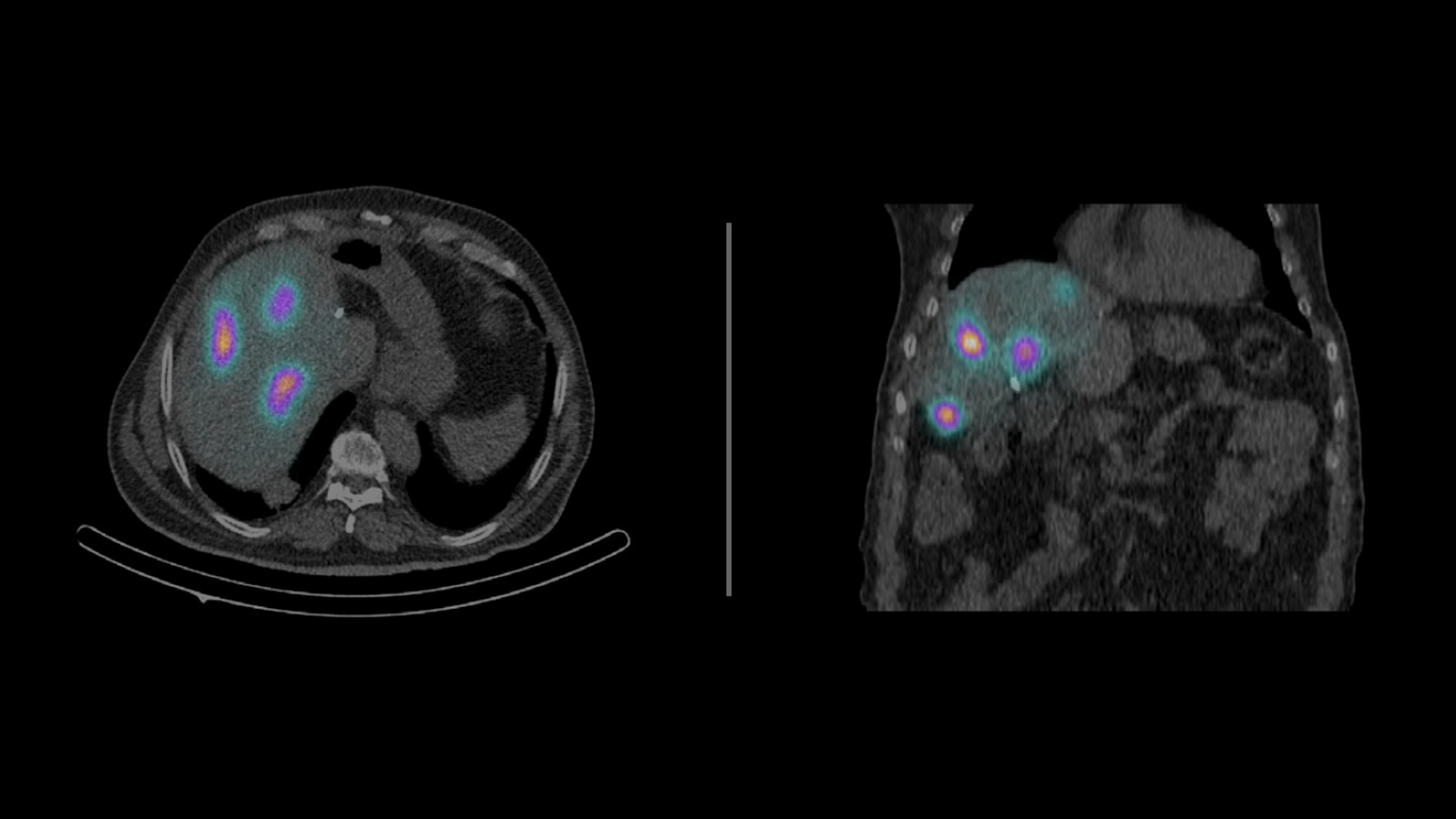 Fused axial (left) and coronal (right) Symbia Pro.specta SPECT/CT images of liver tumor perfusion with hepatic arterial catheter infusion of 99mTc-MAA prior to 90Y-microsphere radioembolizationselective internal radiation therapy (SIRT).