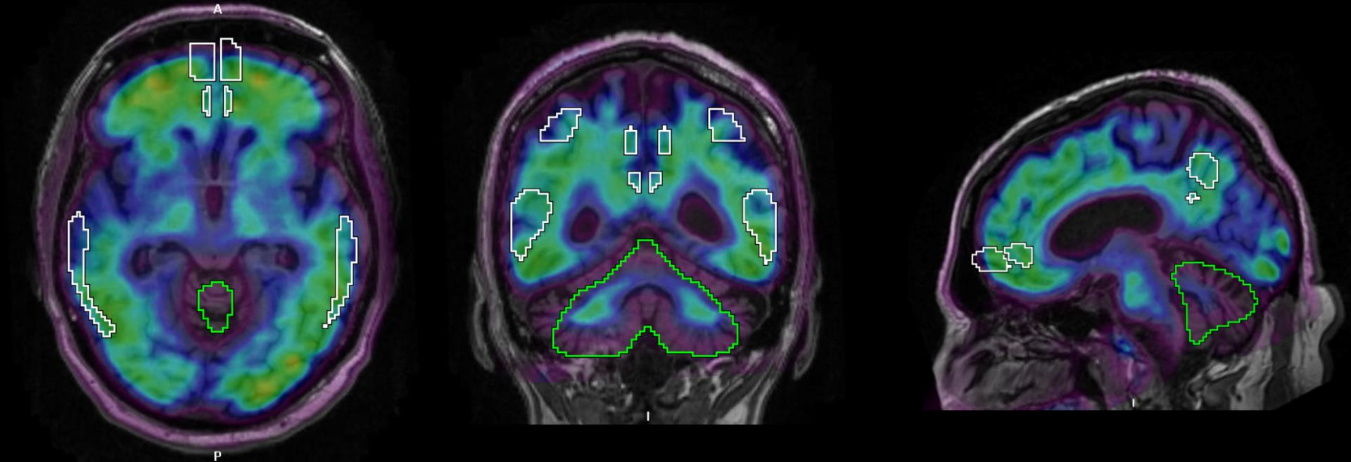 PET/CT biomarkers enable clinicians to advance Alzheimer’s disease care ...