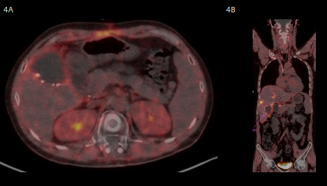 Fig 4A & 4B: A follow-up PET-CT demonstrated significant metabolic regression of retrocrural and upper abdom- inal lymphadenopathies