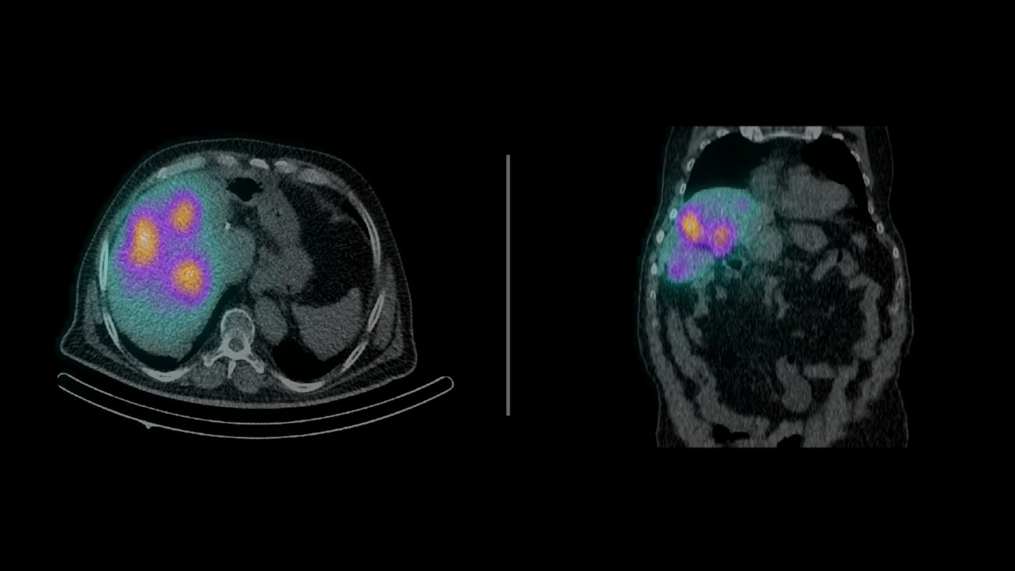 Fused axial (left) and coronal (right) Symbia Pro.specta Bremsstrahlung SPECT/CT images of 90Y SIR-Spheres accumulation within liver tumor following SIRT.