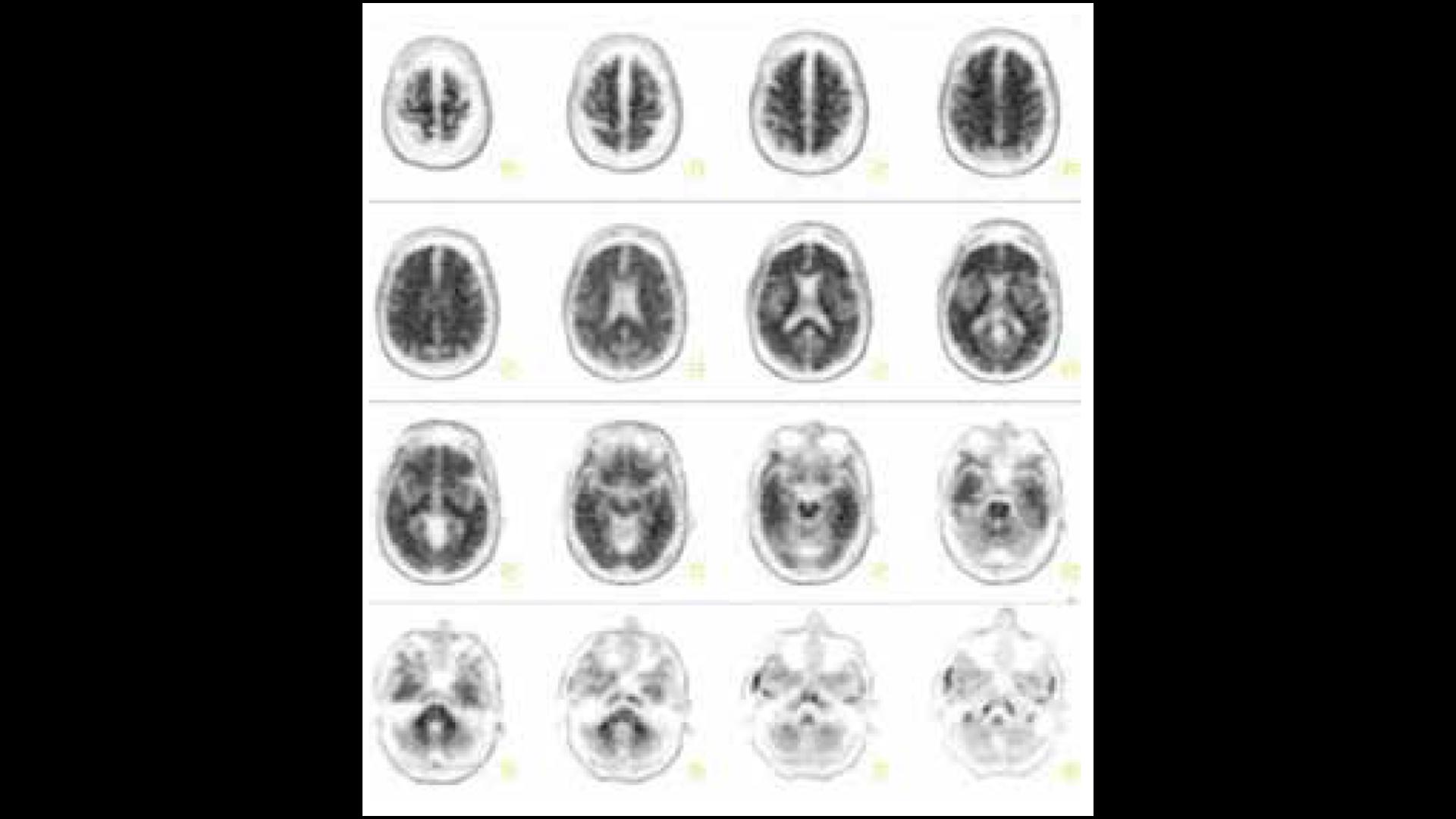 Betaamyloid PET imaging for Alzheimer's disease Siemens Healthineers