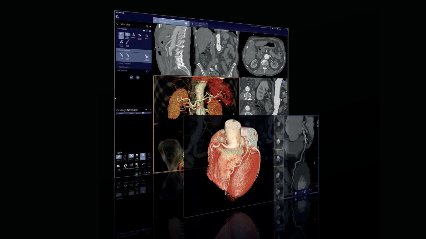 Heart tomography