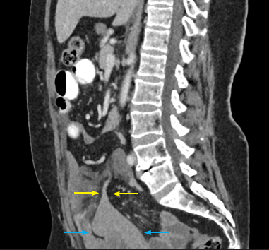 Fig 3: Sagittal CT scan (oral and IV contrast) showed a fibrotic band extending from the fundus of uterus upward to the site of transitional zone.