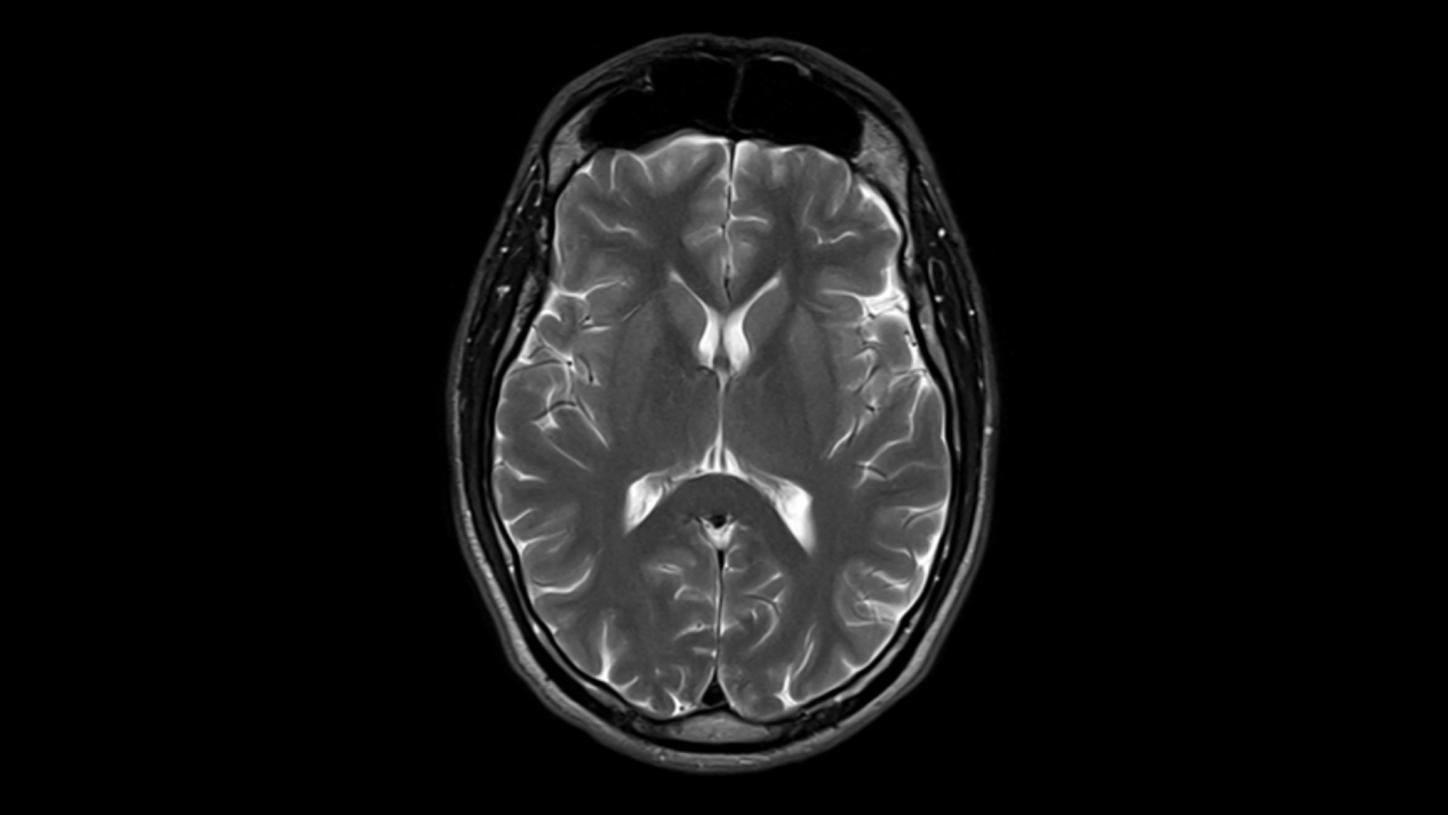 MRI of brain