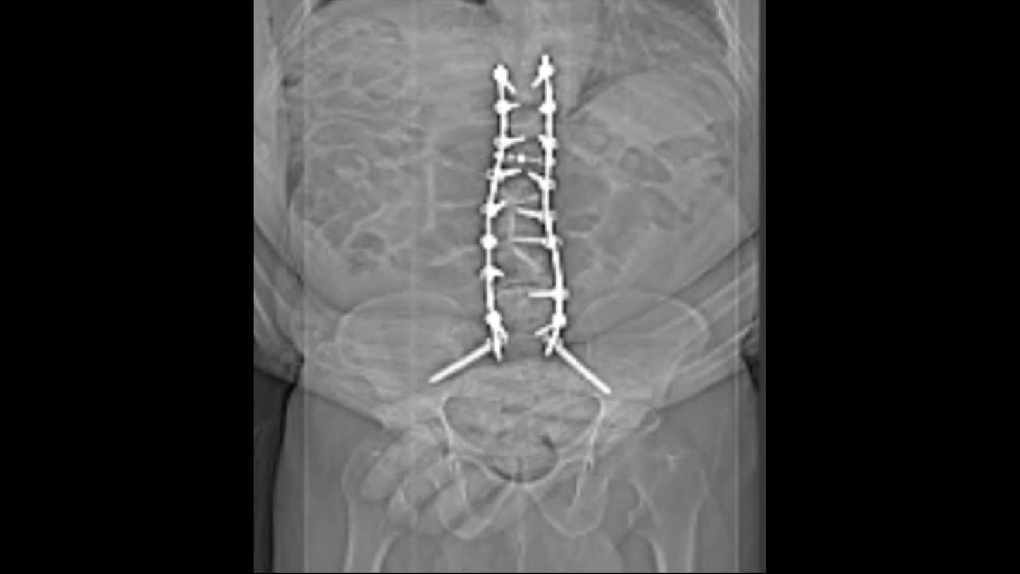 Routine X-ray of lower thoracic and lumbar vertebrae shows bilateral spinal stabilization rod and screws without any clear evidence of displacement or fracture