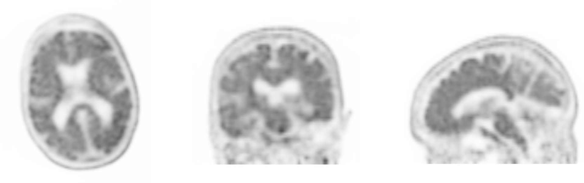 PET/CT biomarkers enable clinicians to advance Alzheimer’s disease care ...