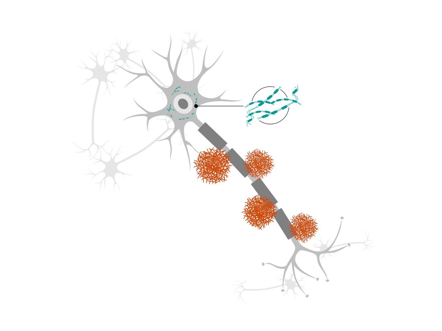 Illustration of damaged neuron with multiple plaques and protein strands.