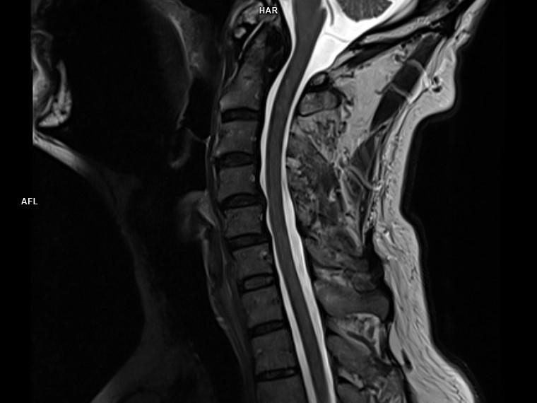 Sagittal T2 TSE-MAGNETOM Lumina/Coil-HeadNeck 20/Spine 24/Resolution-384/Scan Time-2:54